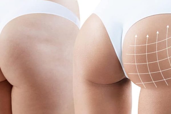 ultrasound-guidwed-fat-transfer
