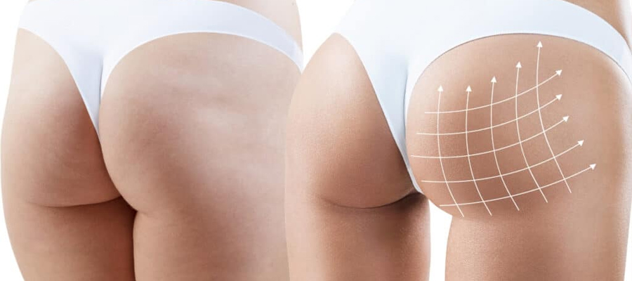 ultrasound-guidwed-fat-transfer