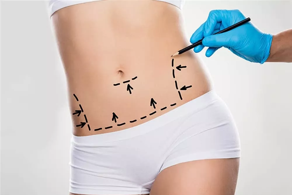 vaser liposuction turkey